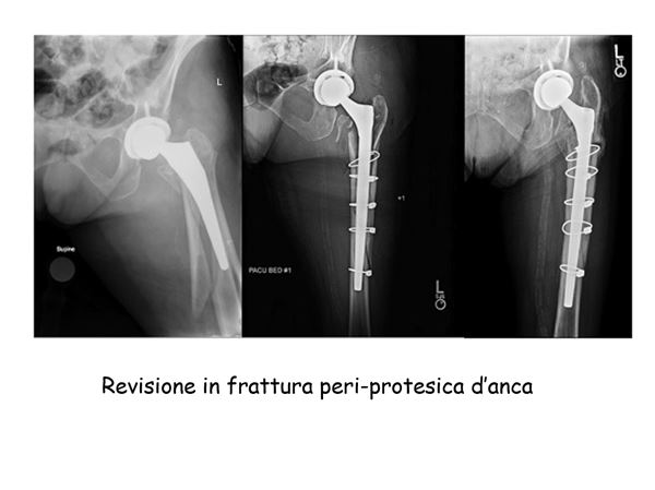 frattura peri protesica