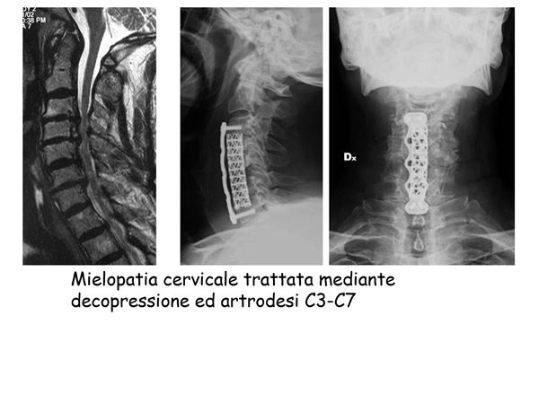 mielopatia cervicale