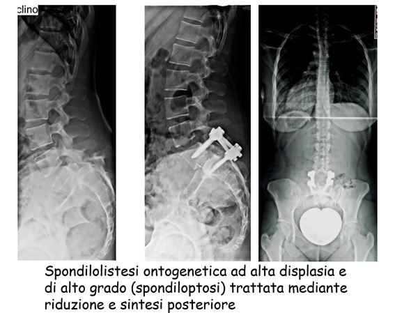 spondilolistesi ontogenetica