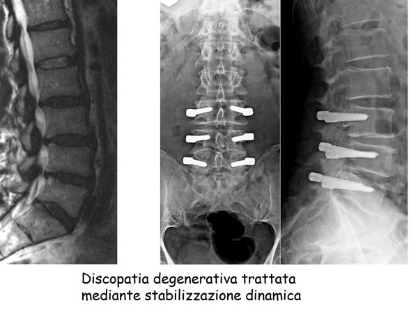 discopatia degenerativa