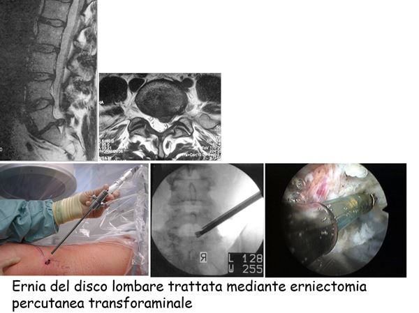 ernia del disco lombare