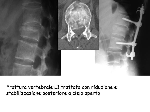 frattura vertebrale L1