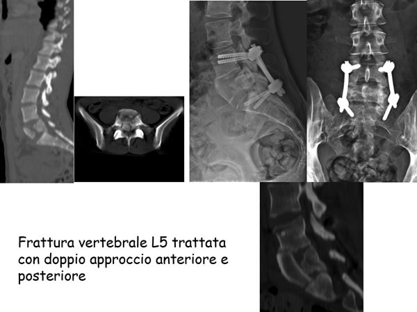 frattura vertebrale L5