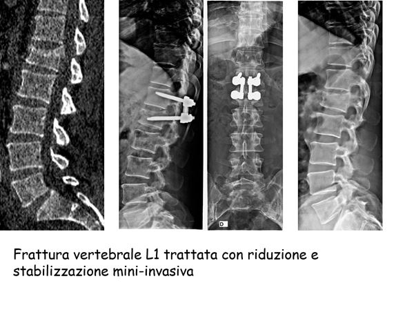 frattura vertebrale L1